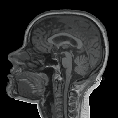 Black and white image. Side profile of Candice's head and brain as it was being scanned by a functional magnetic resonance imaging machine.